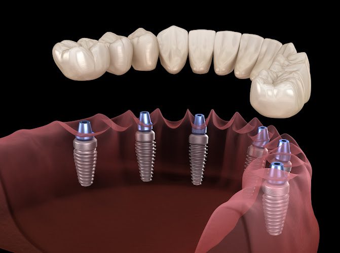 Associates Denture